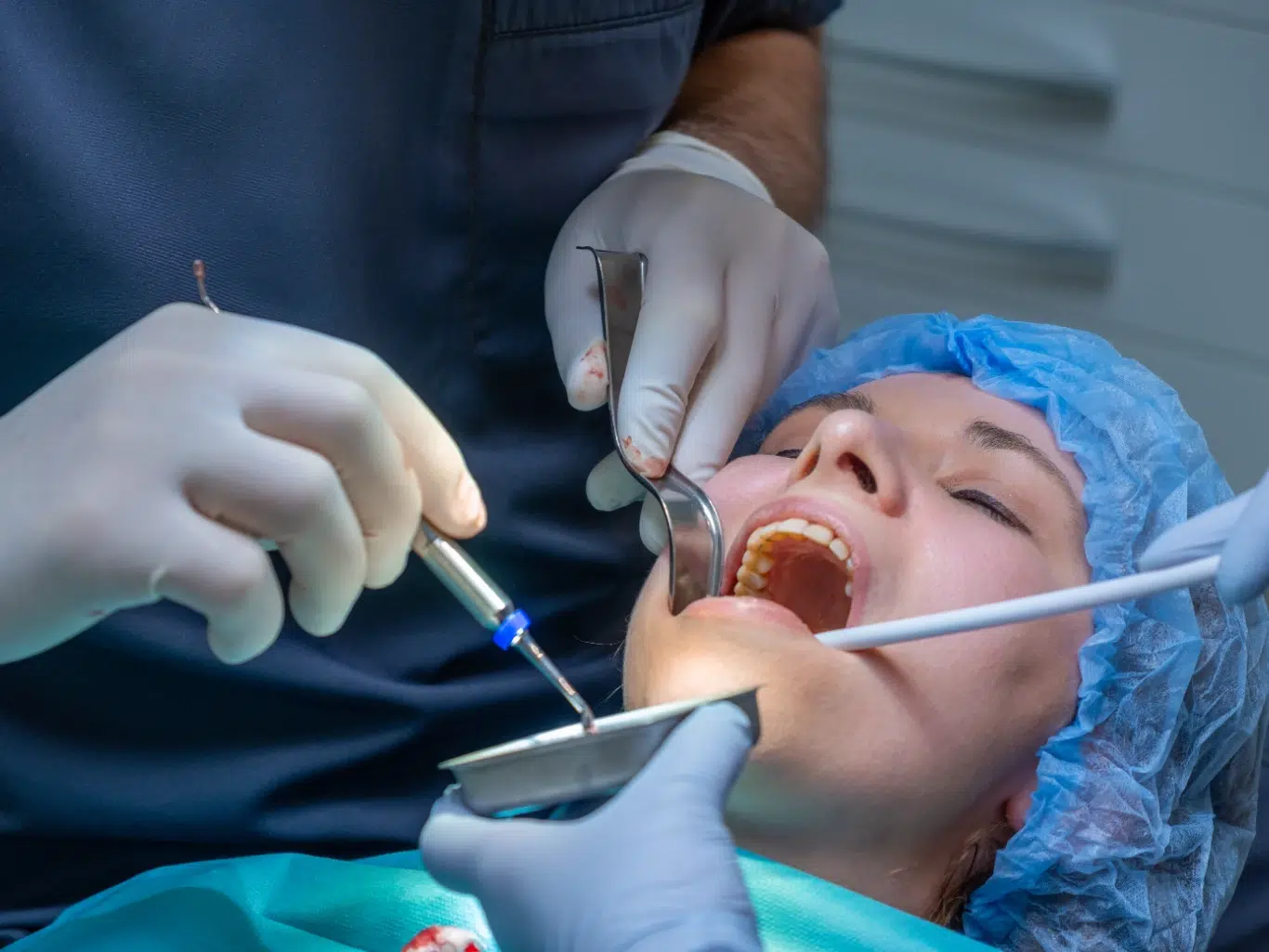 Active Oral Surgery and Dental Implant Procedure A close up clinical view of a patient undergoing oral surgery